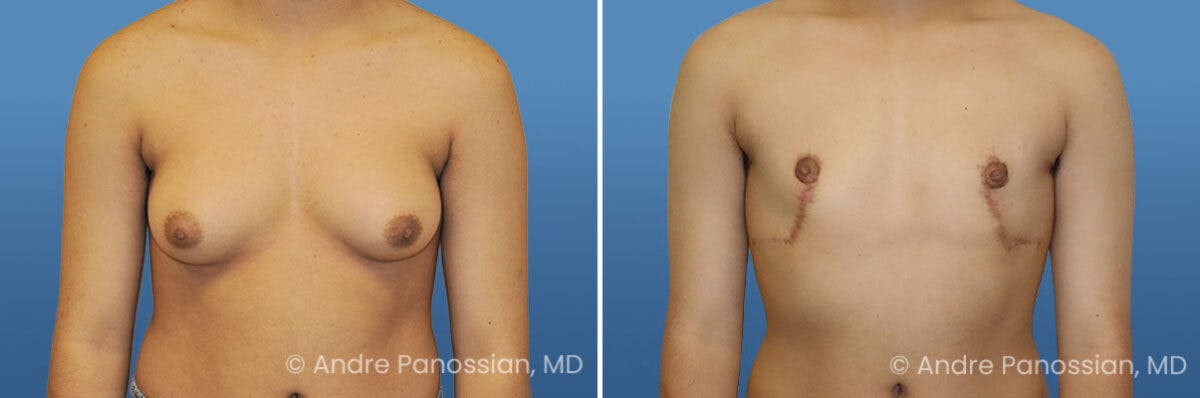 Male Breast Reduction (Gynecomastia) Before & After Gallery - Patient 161699 - Image 1