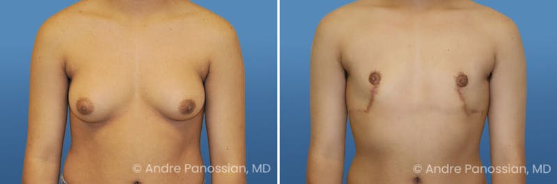 Male Breast Reduction (Gynecomastia) Before & After Gallery - Patient 161699 - Image 1