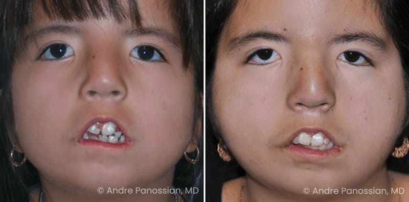 Smile Reanimation Before & After Gallery - Patient 272337 - Image 1