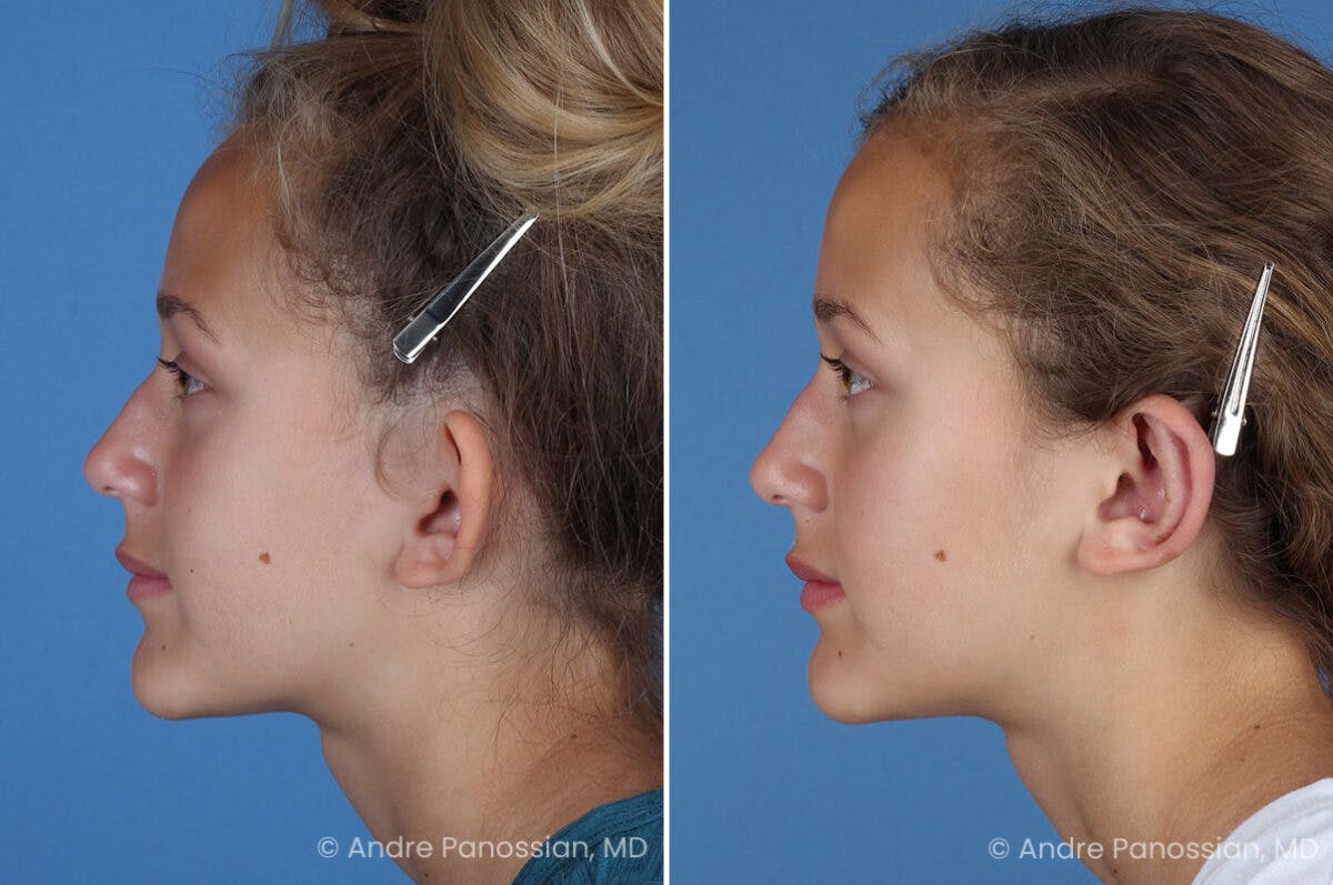 Ear Pinning (Otoplasty) Before & After Gallery - Patient 404369 - Image 5