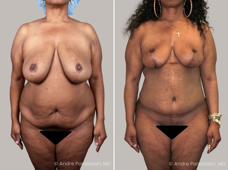 Mommy Makeover Before & After Gallery - Patient 302473 - Image 1