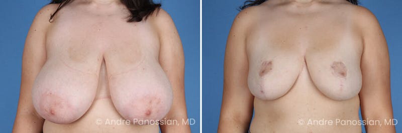 Breast Lift/Reduction Before & After Gallery - Patient 110548 - Image 1