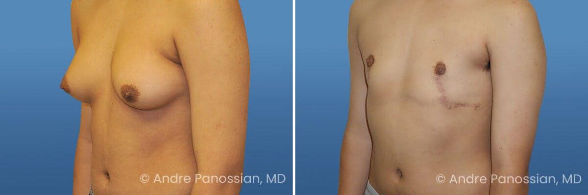 Male Breast Reduction (Gynecomastia) Before & After Gallery - Patient 161699 - Image 2