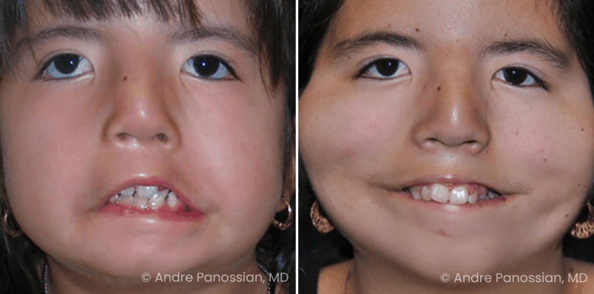 Smile Reanimation Before & After Gallery - Patient 272337 - Image 2