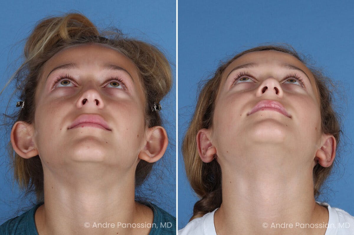 Ear Pinning (Otoplasty) Before & After Gallery - Patient 404369 - Image 6