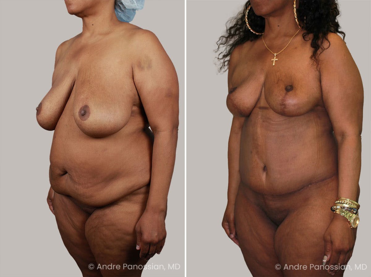Mommy Makeover Before & After Gallery - Patient 302473 - Image 2