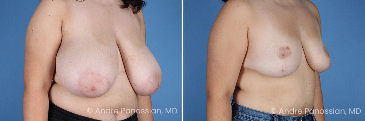Breast Lift/Reduction Before & After Gallery - Patient 110548 - Image 2