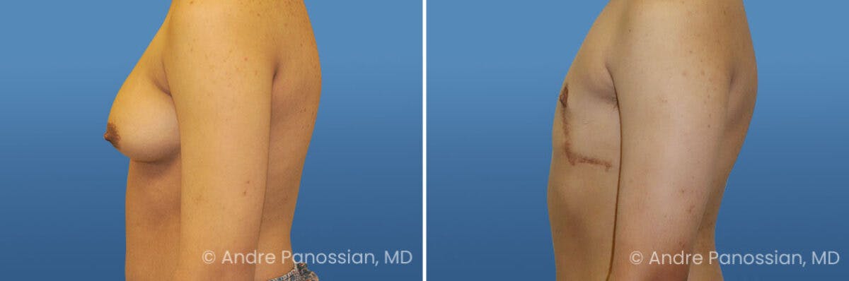 Male Breast Reduction (Gynecomastia) Before & After Gallery - Patient 161699 - Image 3