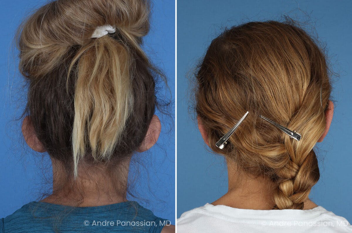 Ear Pinning (Otoplasty) Before & After Gallery - Patient 404369 - Image 7