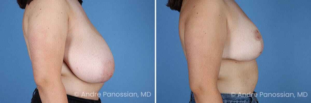 Breast Lift/Reduction Before & After Gallery - Patient 110548 - Image 3