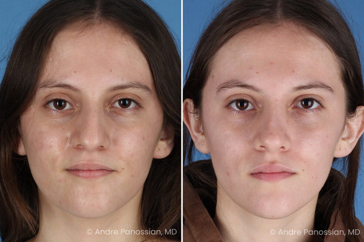 Rhinoplasty Before & After Gallery - Patient 306894 - Image 2