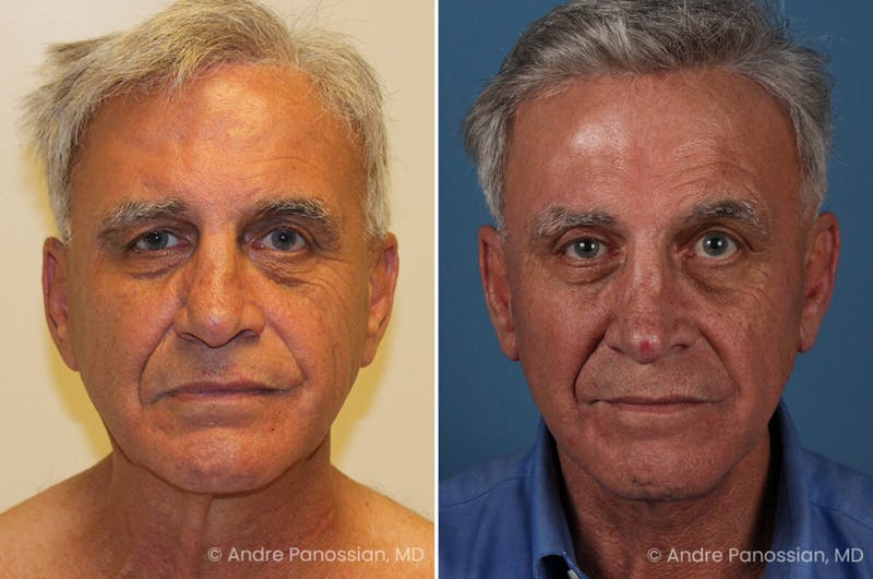 Selective Neurolysis Before & After Gallery - Patient 222021 - Image 1