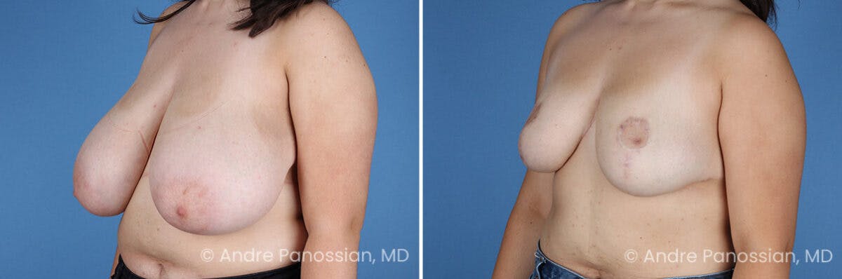 Breast Lift/Reduction Before & After Gallery - Patient 110548 - Image 4