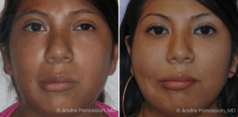 Smile Reanimation Before & After Gallery - Patient 203025 - Image 1