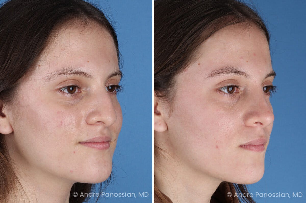 Rhinoplasty Before & After Gallery - Patient 306894 - Image 3