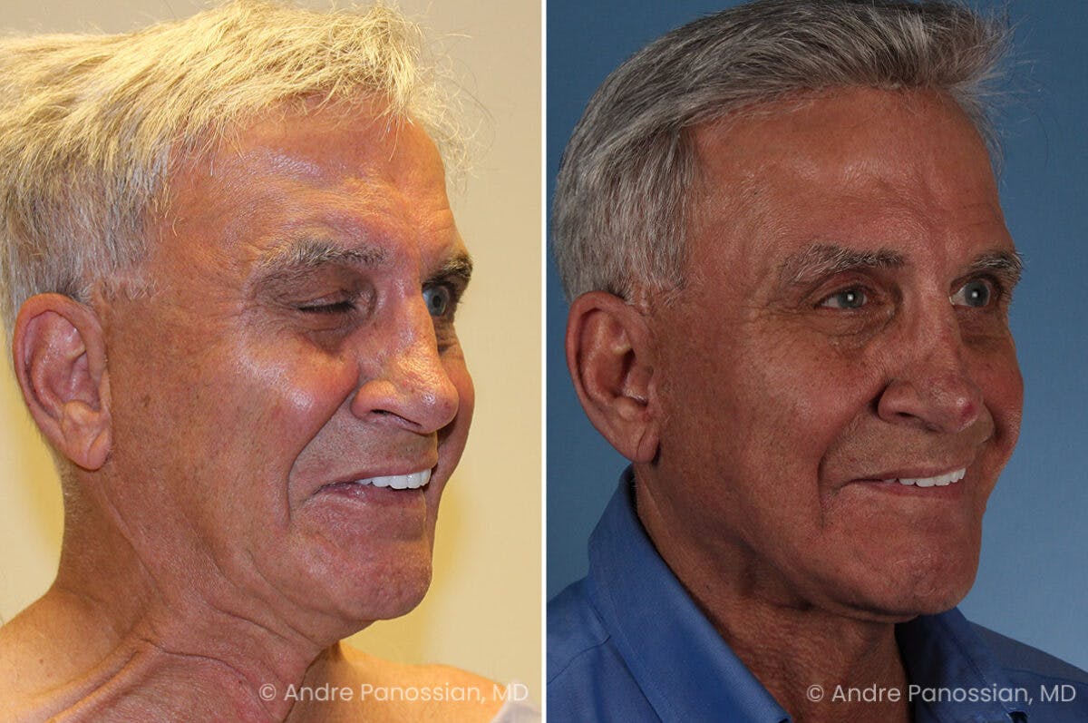 Selective Neurolysis Before & After Gallery - Patient 222021 - Image 2