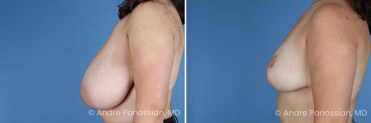 Breast Lift/Reduction Before & After Gallery - Patient 110548 - Image 5
