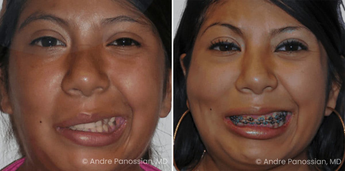 Smile Reanimation Before & After Gallery - Patient 203025 - Image 2
