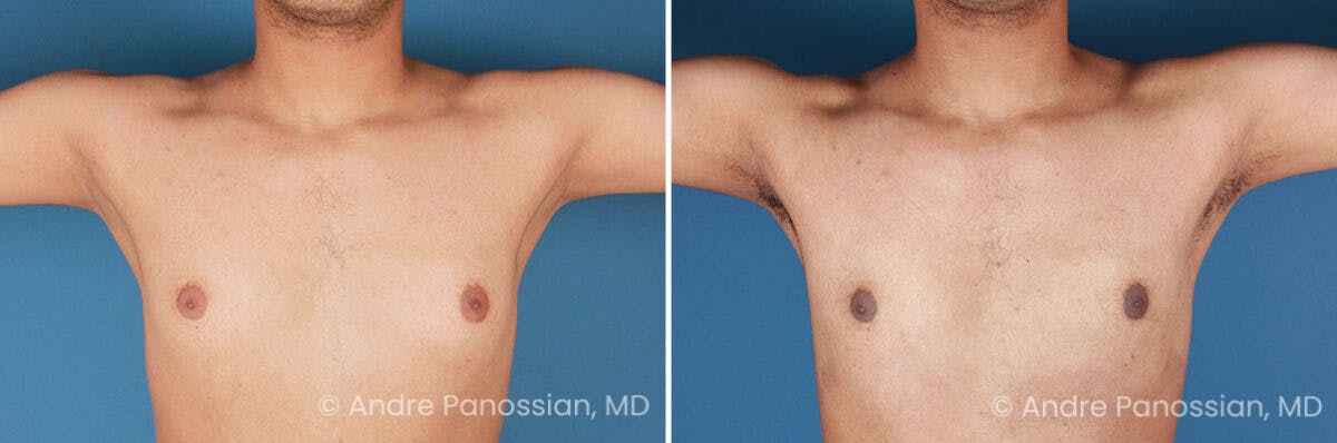 Male Breast Reduction (Gynecomastia) Before & After Gallery - Patient 170728 - Image 1