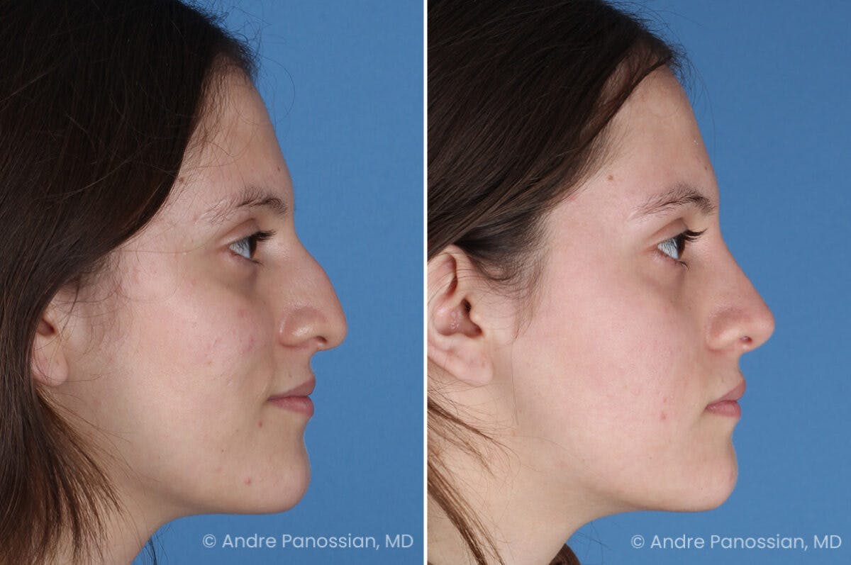 Rhinoplasty Before & After Gallery - Patient 306894 - Image 1