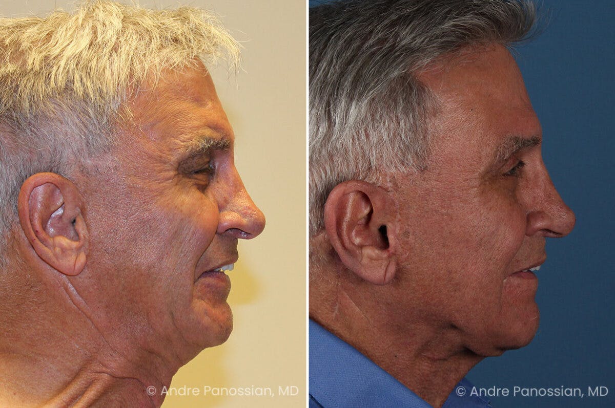 Selective Neurolysis Before & After Gallery - Patient 222021 - Image 3