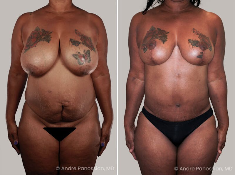 Mommy Makeover Before & After Gallery - Patient 128018 - Image 1