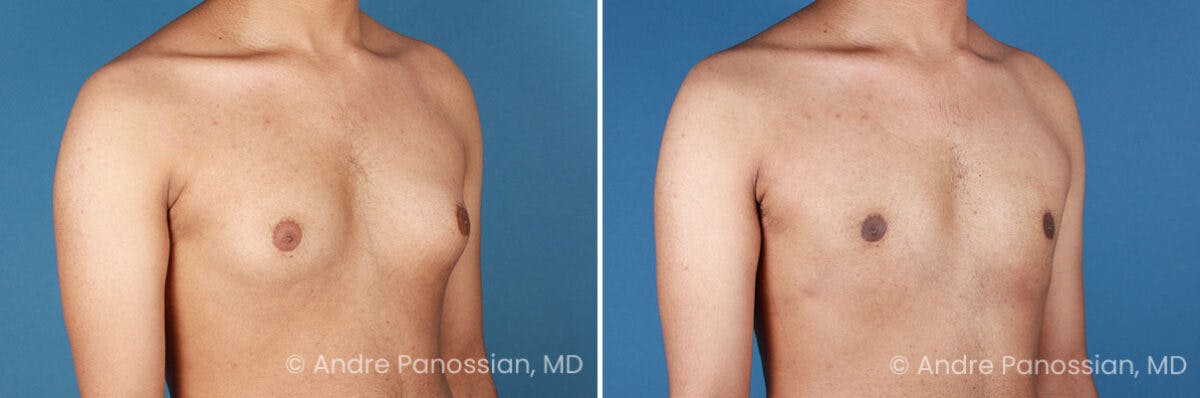 Male Breast Reduction (Gynecomastia) Before & After Gallery - Patient 170728 - Image 2