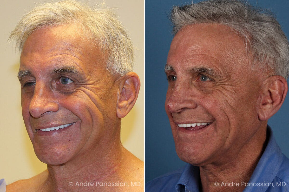 Selective Neurolysis Before & After Gallery - Patient 222021 - Image 4