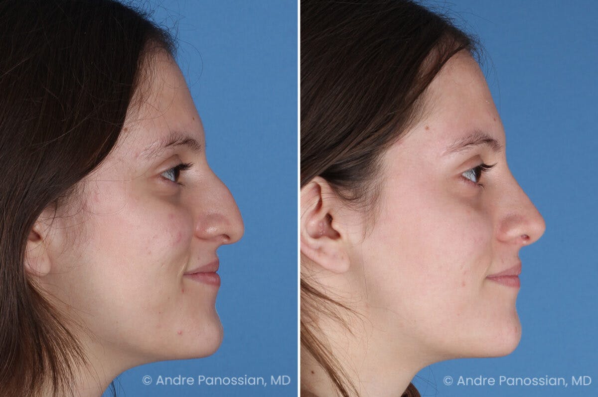 Rhinoplasty Before & After Gallery - Patient 306894 - Image 4