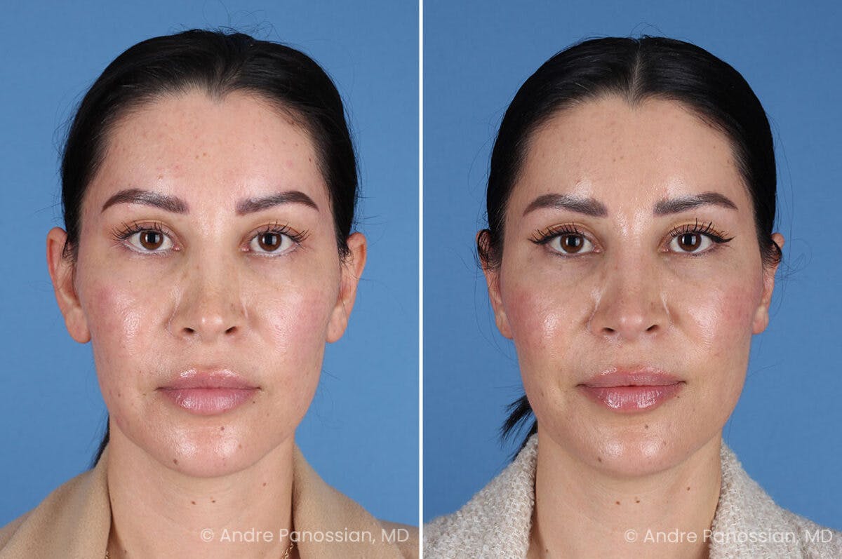 Ear Pinning (Otoplasty) Before & After Gallery - Patient 227974 - Image 1