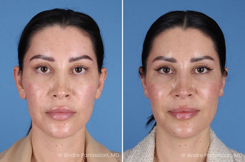 Ear Pinning (Otoplasty) Before & After Gallery - Patient 227974 - Image 1