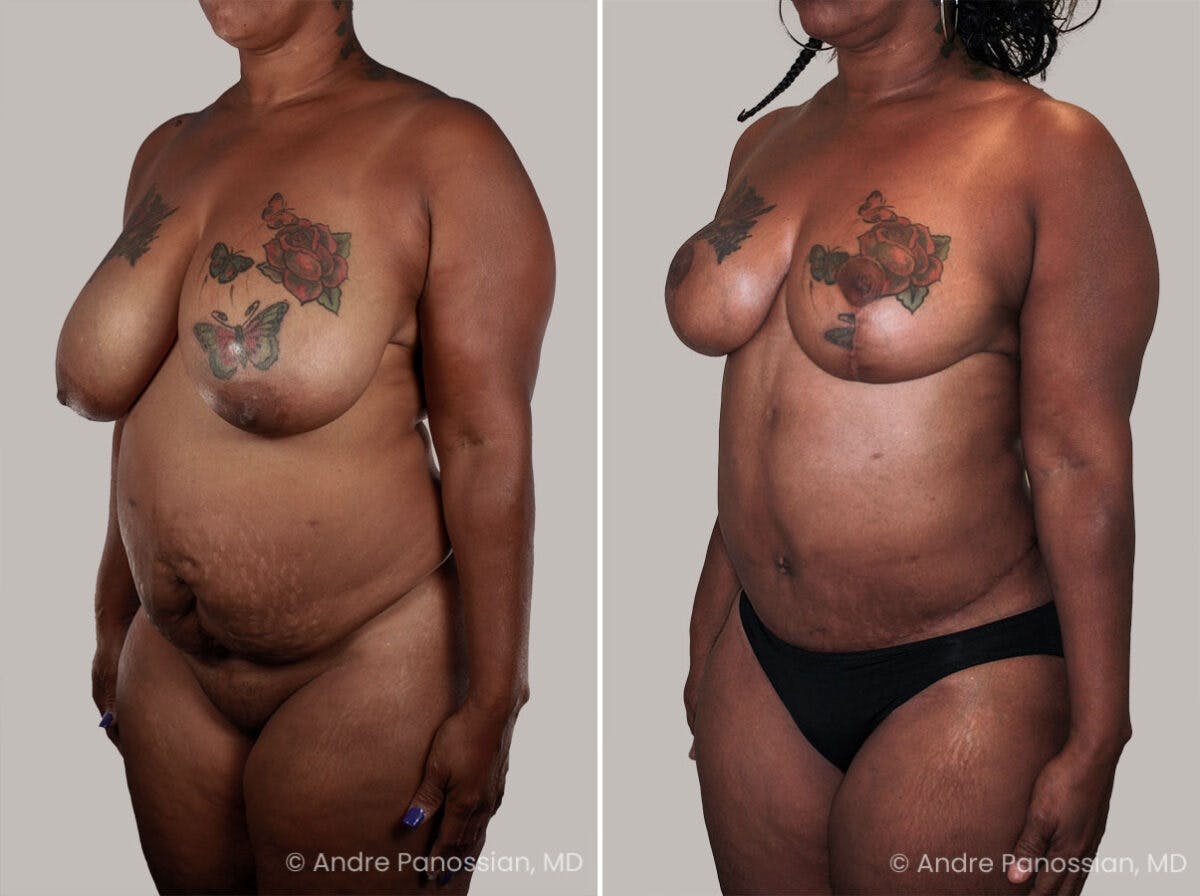 Mommy Makeover Before & After Gallery - Patient 128018 - Image 2