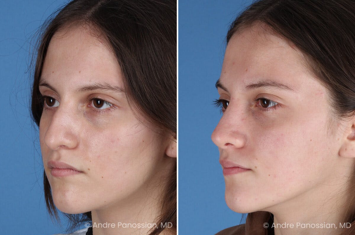 Rhinoplasty Before & After Gallery - Patient 306894 - Image 5
