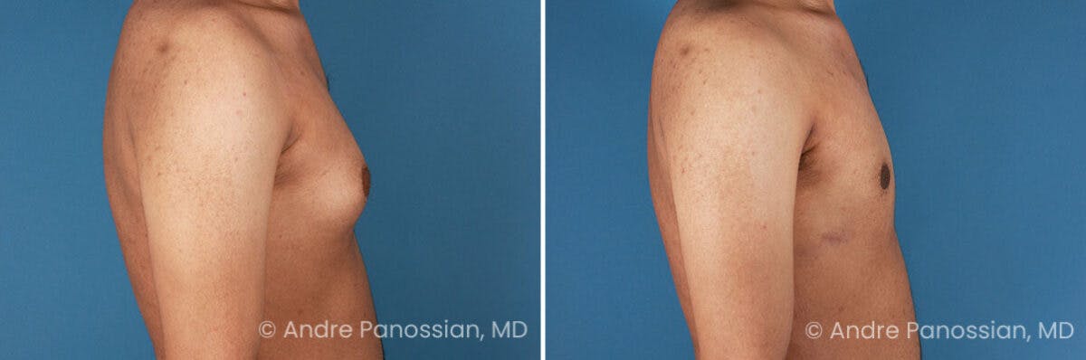 Male Breast Reduction (Gynecomastia) Before & After Gallery - Patient 170728 - Image 3