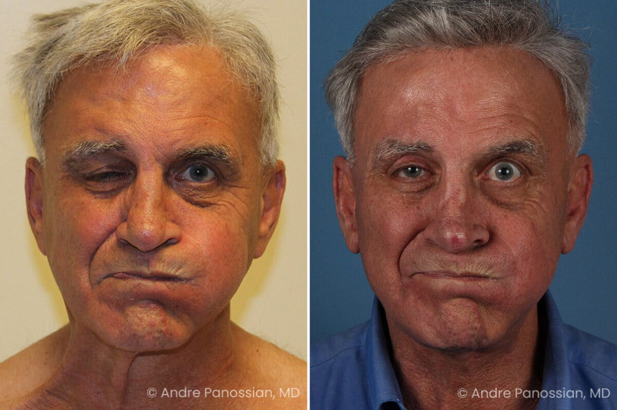 Selective Neurolysis Before & After Gallery - Patient 222021 - Image 5