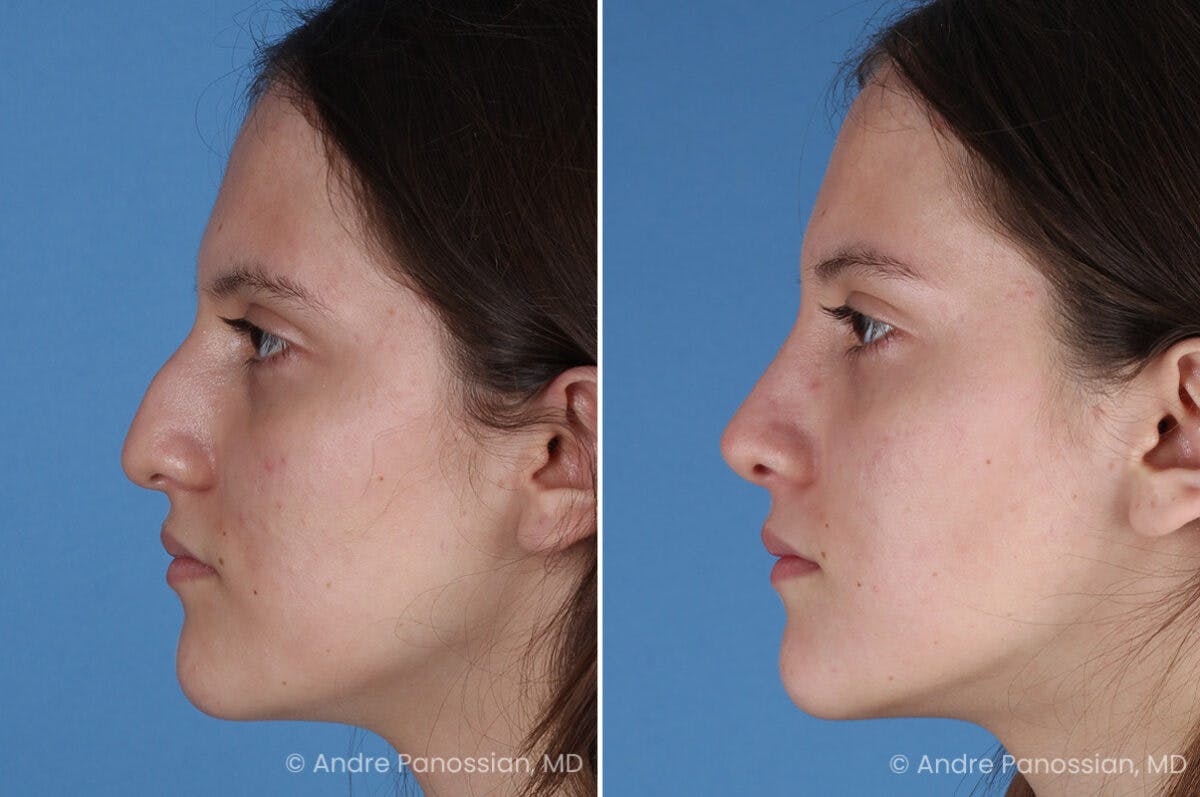 Rhinoplasty Before & After Gallery - Patient 306894 - Image 6