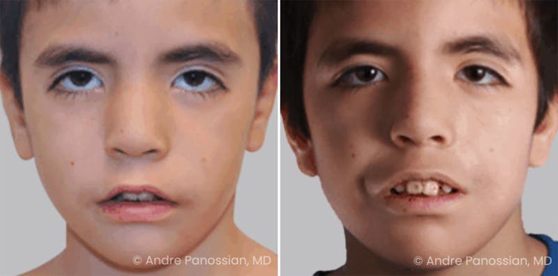 Smile Reanimation Before & After Gallery - Patient 811354 - Image 1