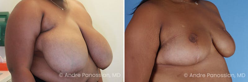 Breast Lift/Reduction Before & After Gallery - Patient 555500 - Image 1