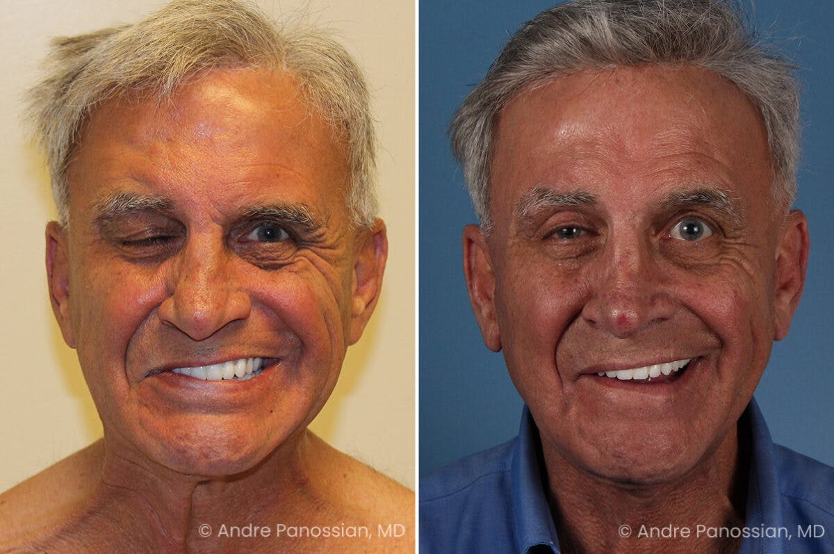 Selective Neurolysis Before & After Gallery - Patient 222021 - Image 6