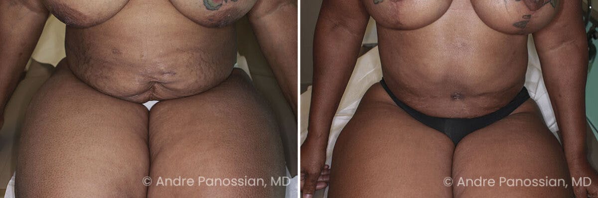 Mommy Makeover Before & After Gallery - Patient 128018 - Image 4