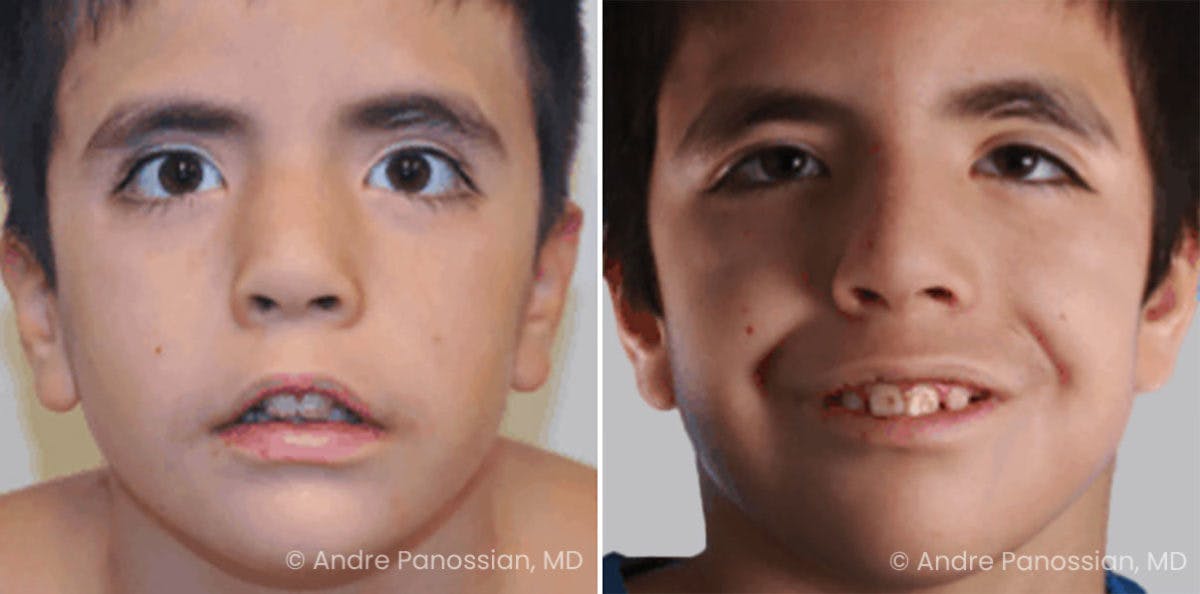 Smile Reanimation Before & After Gallery - Patient 811354 - Image 2
