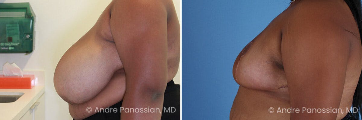 Breast Lift/Reduction Before & After Gallery - Patient 555500 - Image 2