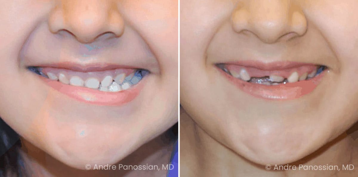 Symmetry Procedures Before & After Gallery - Patient 291606 - Image 1