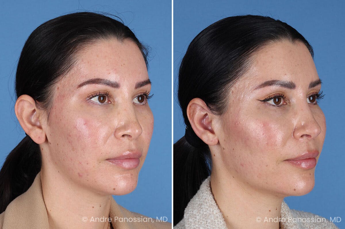 Ear Pinning (Otoplasty) Before & After Gallery - Patient 227974 - Image 2