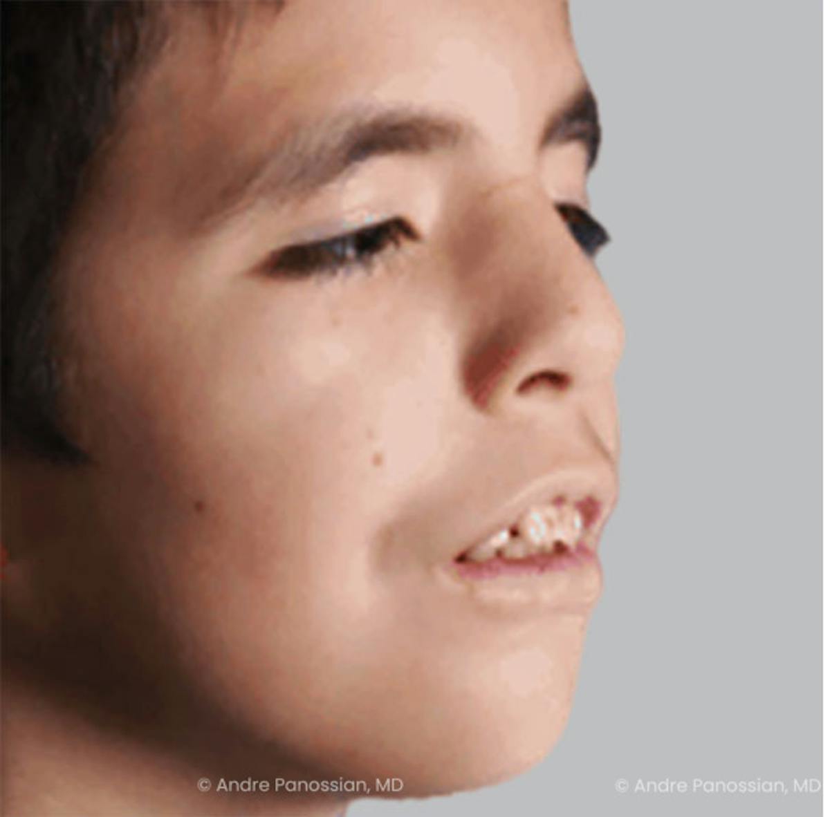 Smile Reanimation Before & After Gallery - Patient 811354 - Image 3