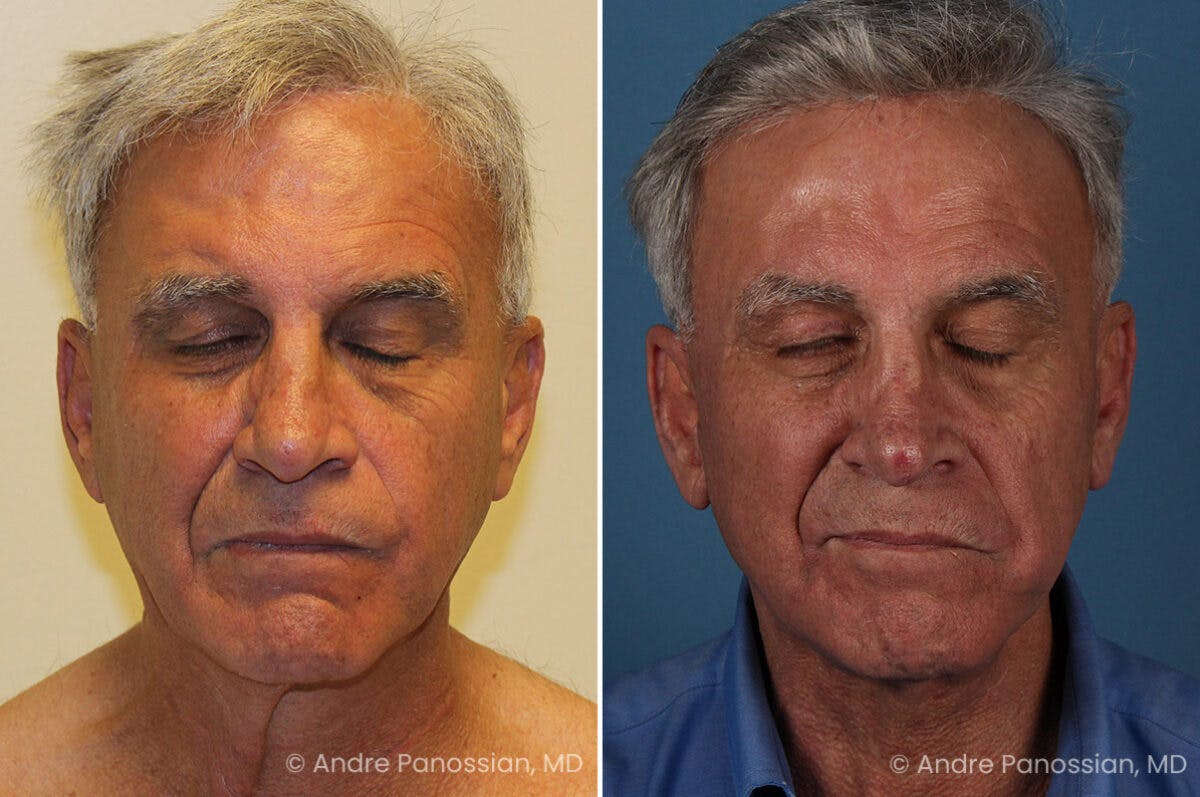 Selective Neurolysis Before & After Gallery - Patient 222021 - Image 7