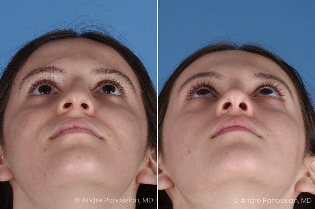 Rhinoplasty Before & After Gallery - Patient 306894 - Image 8
