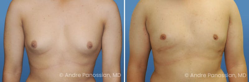 Male Breast Reduction (Gynecomastia) Before & After Gallery - Patient 235630 - Image 1