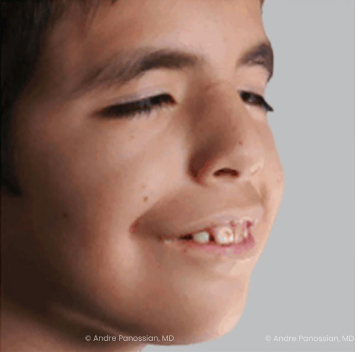 Smile Reanimation Before & After Gallery - Patient 811354 - Image 4