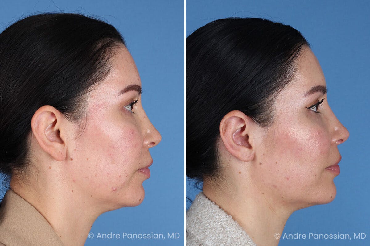 Ear Pinning (Otoplasty) Before & After Gallery - Patient 227974 - Image 3